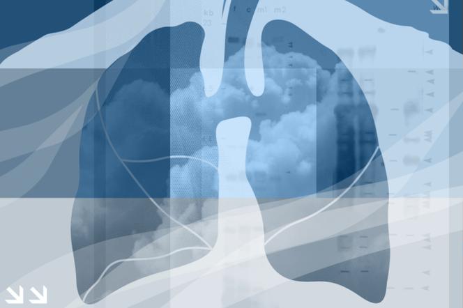Pochp Przewlekła Obturacyjna Choroba Płuc Przyczyny Objawy I 4951