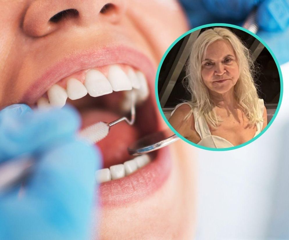 Dentystka Anita z „Sanatorium miłości” krytykuje modę na licówki z Turcji. Utrata zębów za hollywoodzki uśmiech