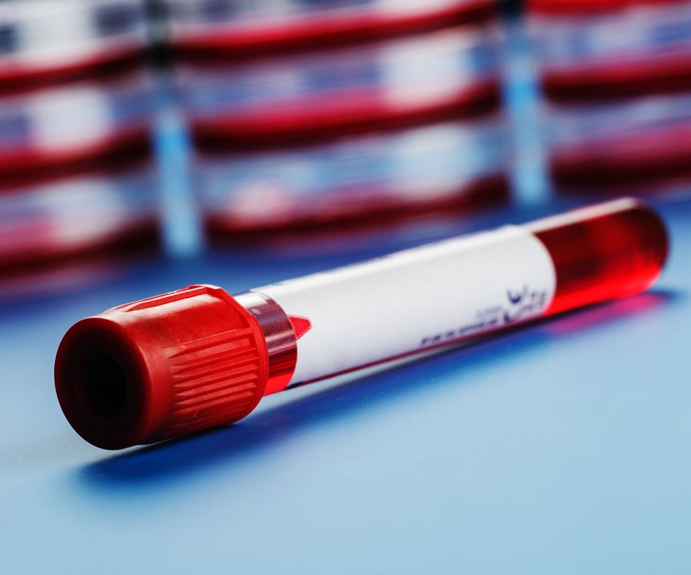 D-dimery - norma i wyniki. Co oznaczają podwyższone D-dimery?