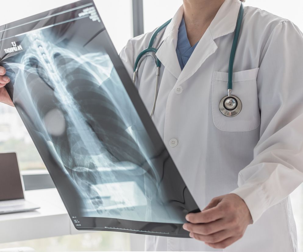Lekarz w białym kitlu ze stetoskopem na szyi trzyma kliszę rentgenowską przedstawiającą ludzką klatkę piersiową. Obraz symbolizuje diagnostykę i leczenie raka płuca, o którym można przeczytać na portalu Poradnik Zdrowie.