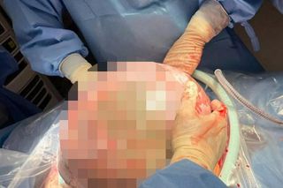 Ogromny guz jajnika usunięty w Centrum Onkologii w Bydgoszczy