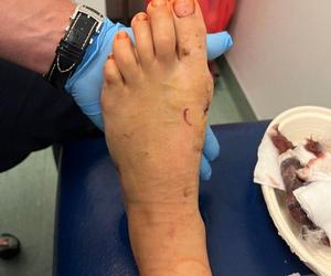 Chorzów. Innowacyjny zabieg u dziecka przeprowadzony po raz pierwszy na Śląsku