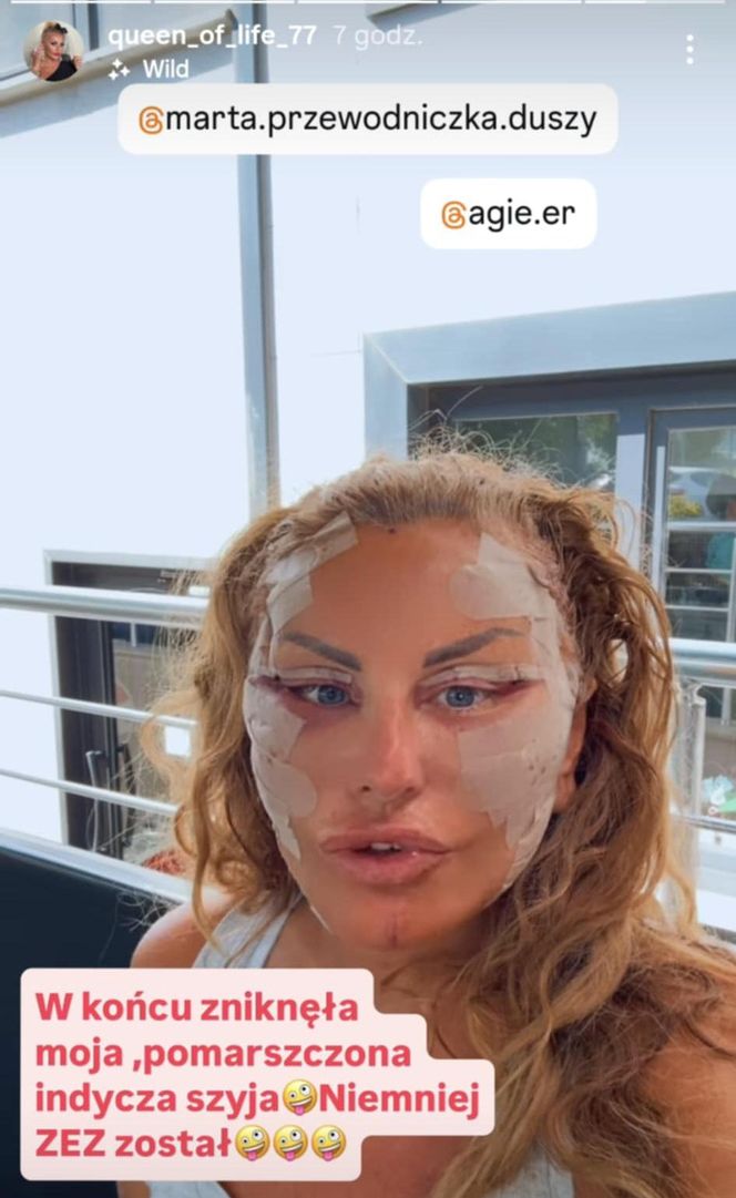 Dagmara Kaźmierska po operacji twarzy