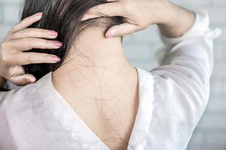 Utrata włosów po metforminie - czy jest to częste zjawisko? Z czego wynika?