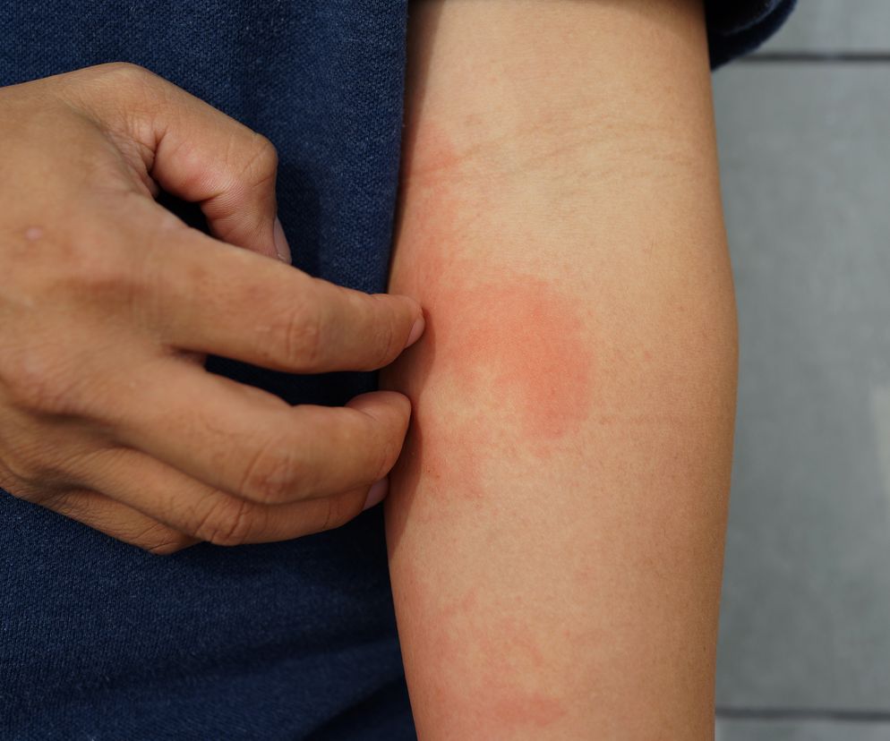 Cholestaza (zastój żółci) - przyczyny, objawy i leczenie