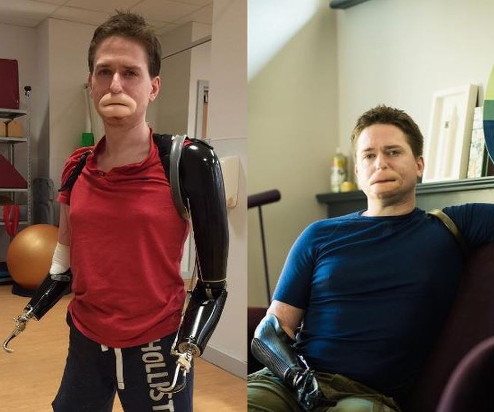 Myślał, że to męska grypa. Z powodu paciorkowca A stracił część twarzy i wszystkie kończyny