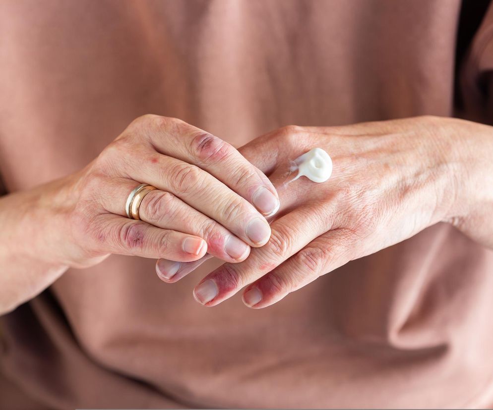 Zwróć uwagę na swoje dłonie. Mogą ujawniać dwie poważne choroby skóry