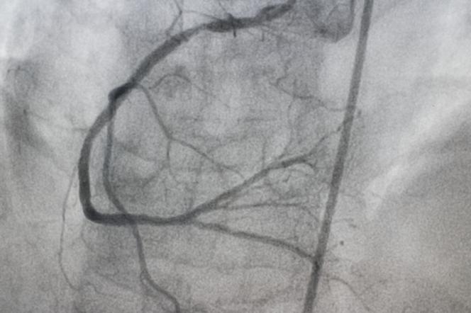 Arteriografia: badanie RTG tętnic