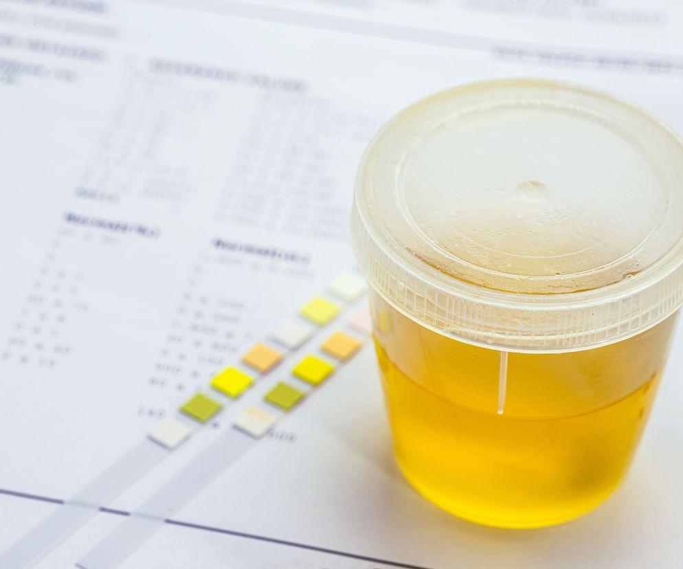 zbliżenie na próbkę moczu