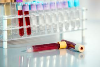 Badanie krwi na raka wykrywa mutacje genu BRCA