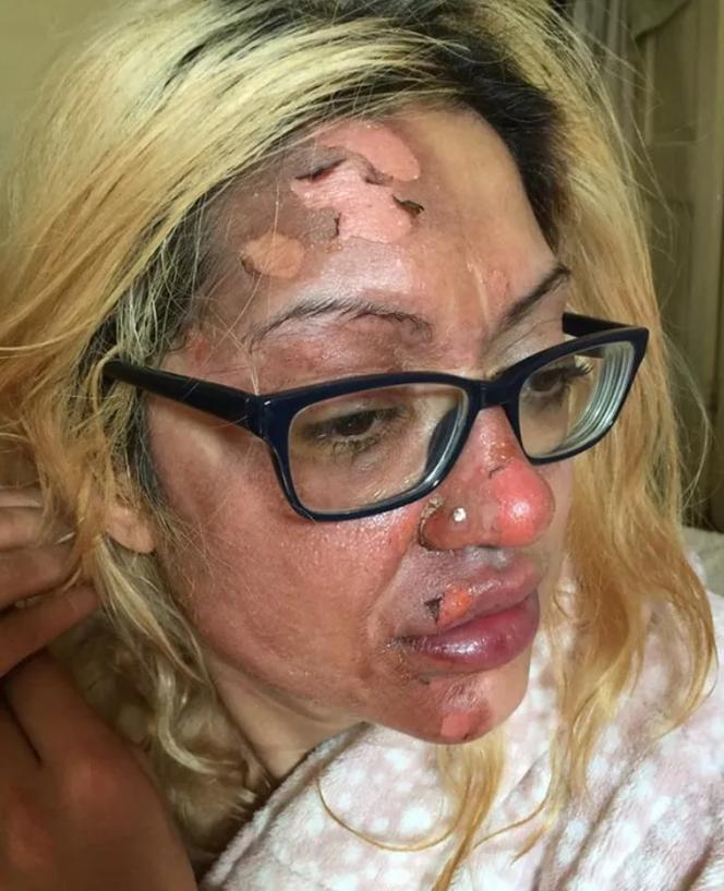 Niebezpieczny trend z TikToka. Kobieta poparzyła pół twarzy