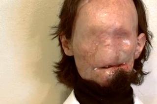 USA: Człowiek bez twarzy – Dallas Wiens dostał nową twarz SZOKUJĄCE ZDJĘCIA 