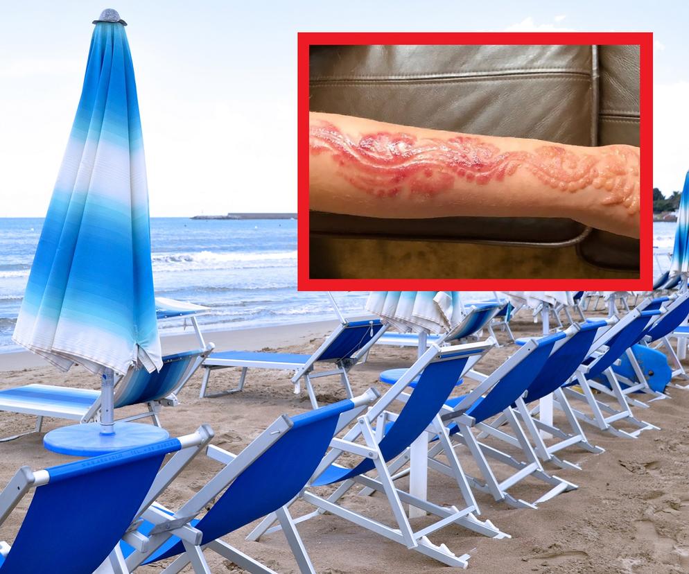 Tatuaż z henny zakończył się poparzeniem dłoni