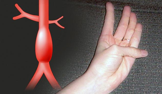 Prosty test z udziałem kciuka może wykryć ukrytego tętniaka aorty. ZOBACZ jak go zrobić!