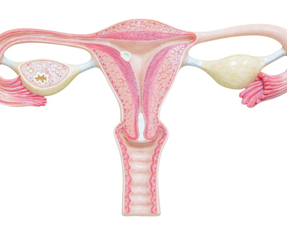 Wodniak jajowodu to stosunkowo częste powikłanie stanów zapalnych w obrębie miednicy mniejszej.