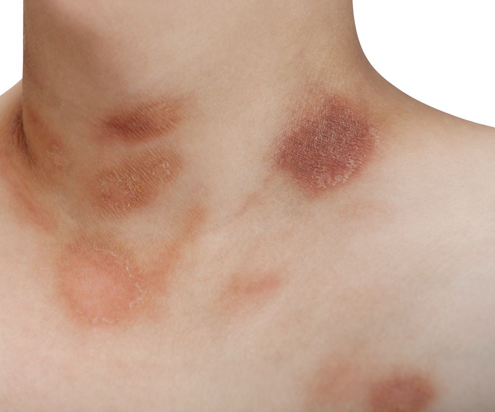 Łupież różowy Giberta: przyczyny, objawy, leczenie