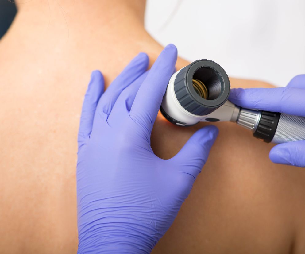 Rumień guzowaty może potwierdzić tylko dermatolog