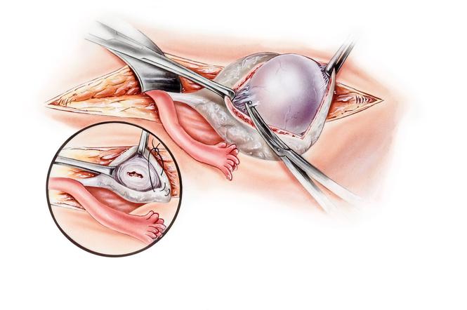 Torbiel skórzasta jajnika: przyczyny, objawy, leczenie