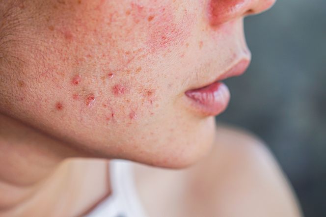 zbliżenie na skórę kobiety pokrytą trądzikiem hormonalnym