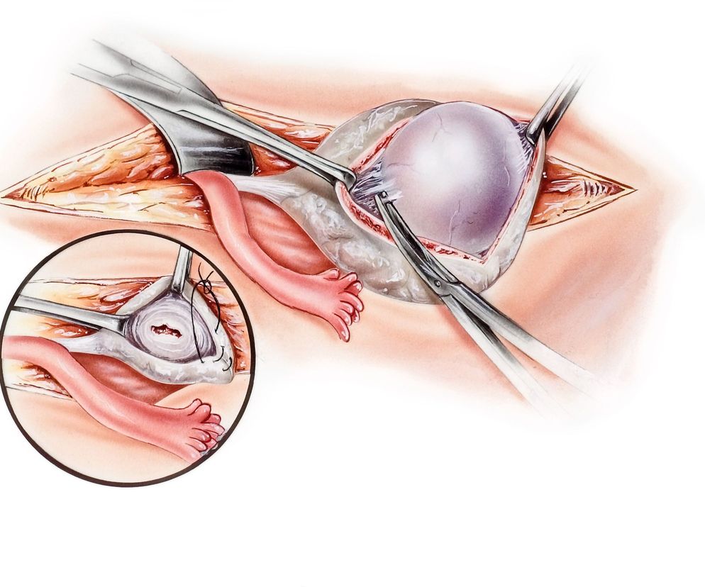 Torbiel skórzasta jajnika (torbiel dermoidalna) to rodzaj łagodnej zmiany nowotworowej (potworniaka).
