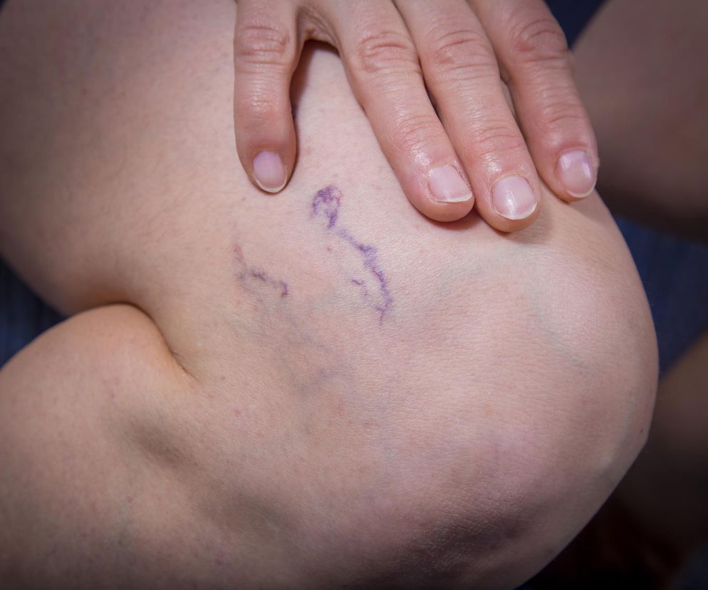 Ludzie lekceważą te objawy zakrzepicy. Co czwarta osoba umiera