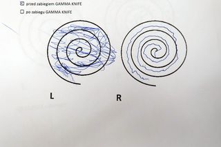 Radiowy nóż naprawia moje ręce