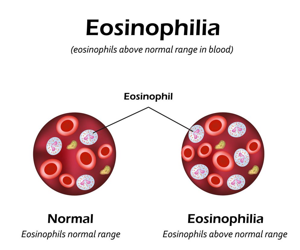 Eozynofilia: rodzaje i przyczyny