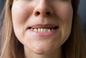 Na dr Smile nabrały się tysiące, nadal za to płacą. Czy można wyprostować zęby bez aparatu?