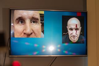 Ranny w wybuchu saper odzyskał dawny wygląd