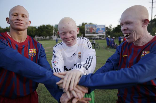 Albinos United