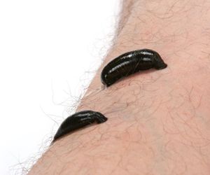 Hirudoterapia. Leczenie pijawkami: opinie