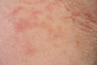 GRUŹLICA TOCZNIOWA SKÓRY może rozwinąć się w RAKA kolczystokomórkowego skóry