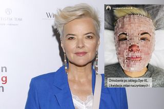 Monika Richardson poddała się bolesnym zabiegom. Usuwa z twarzy resztki po TVP. Mamy zdjęcia!