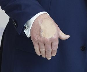 Donald Trump ma kłopoty ze zdrowiem. Nowe zdjęcia wywołały niepokój