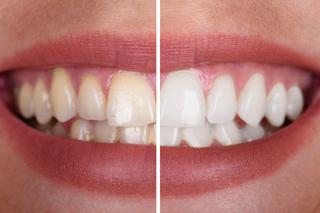 Wybielenie zębów - jak wybielić zęby?