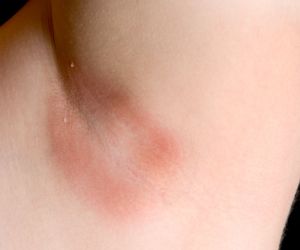 Wyprzenie – przyczyny, objawy, leczenie