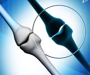 Guz olbrzymiokomórkowy - łagodny nowotwór kości