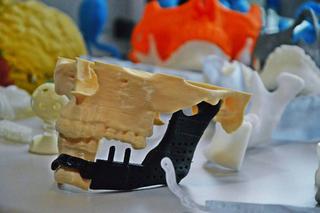 Wydrukowali mu nowe kości twarzy