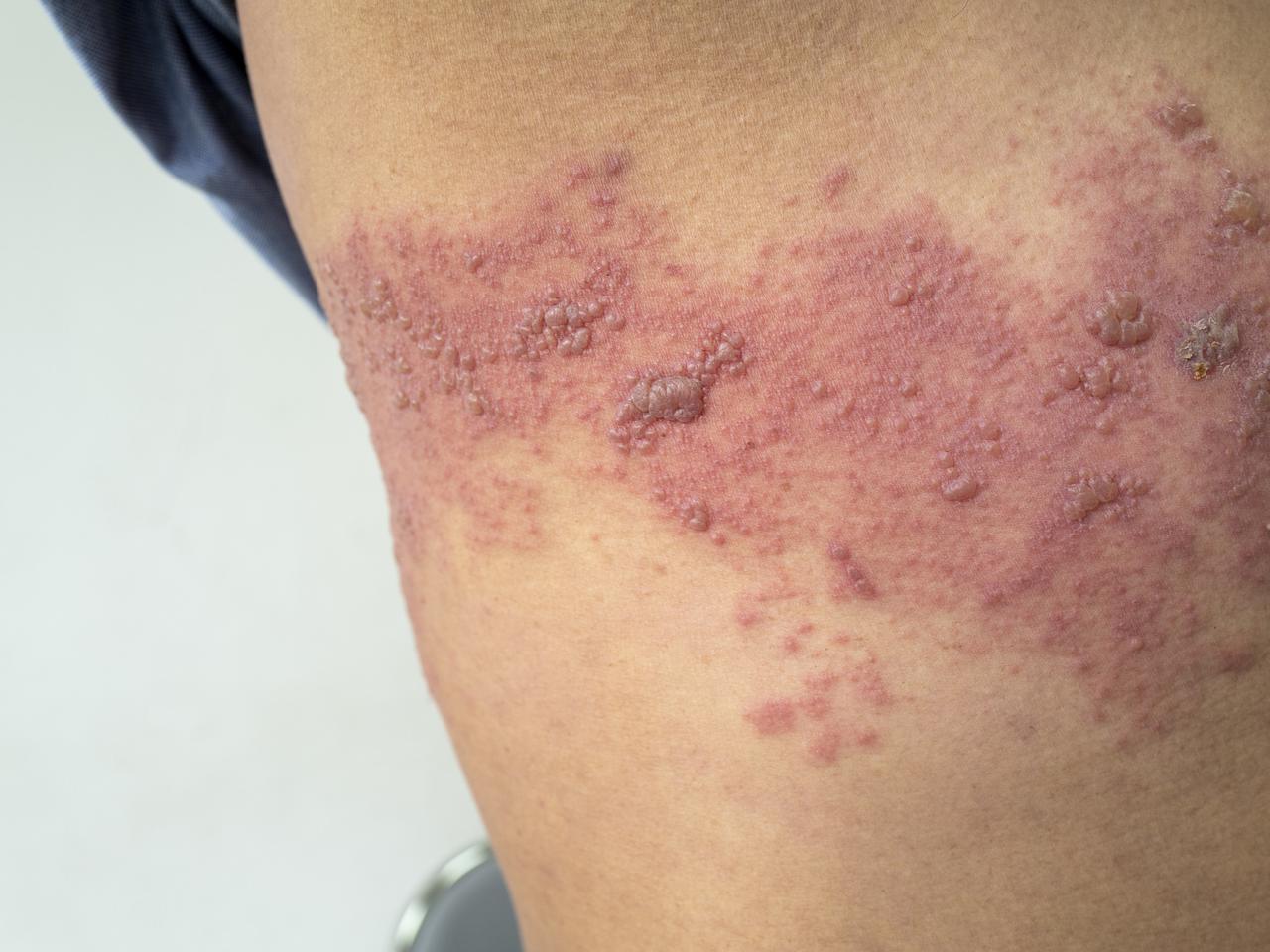 Półpasiec - objawy, leczenie i powikłania. Co to jest półpasiec? 