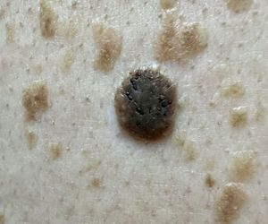 Brodawka łojotokowa czy rak? Dermatolożka apeluje: Nie rozstrzygaj tego samodzielnie!