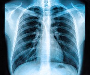 Lejkowata klatka piersiowa: przyczyny, objawy, leczenie