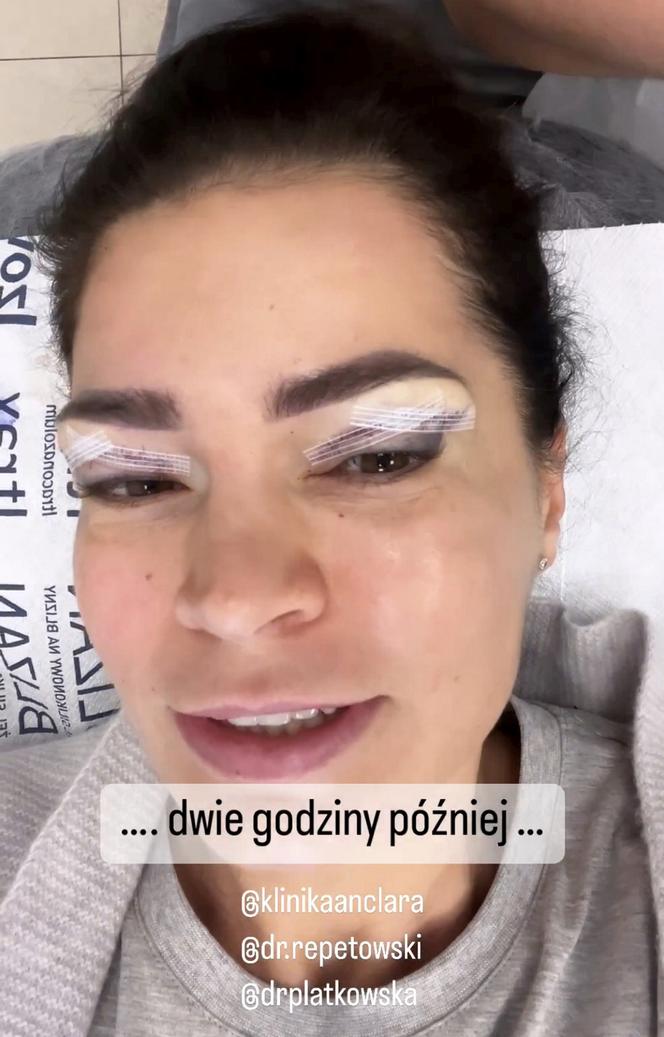 Joanna Górska wycięła sobie powieki. Drastyczne zdjęcia 