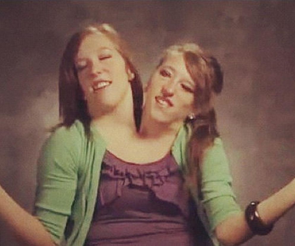 Siostry syjamskie urodziły dziecko?! Sensacyjne doniesienia