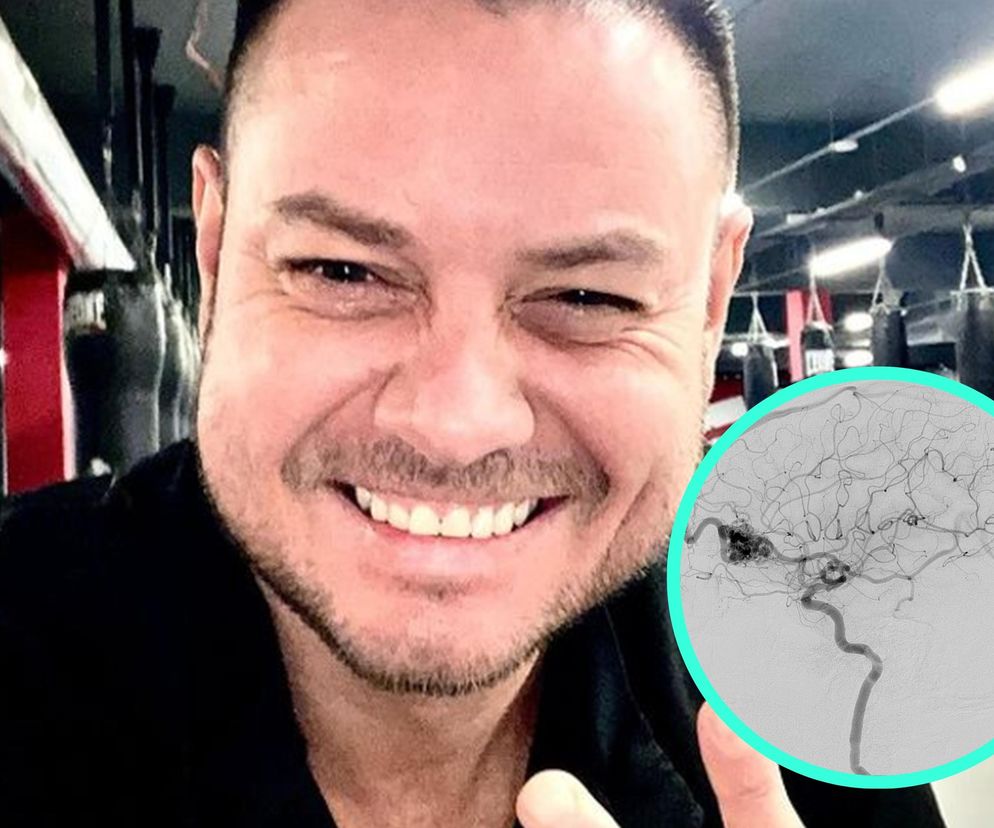 Malformacja naczyniowa, czyli co? Wiele osób zadaje sobie to pytanie po zabiegu Bartka Wrony