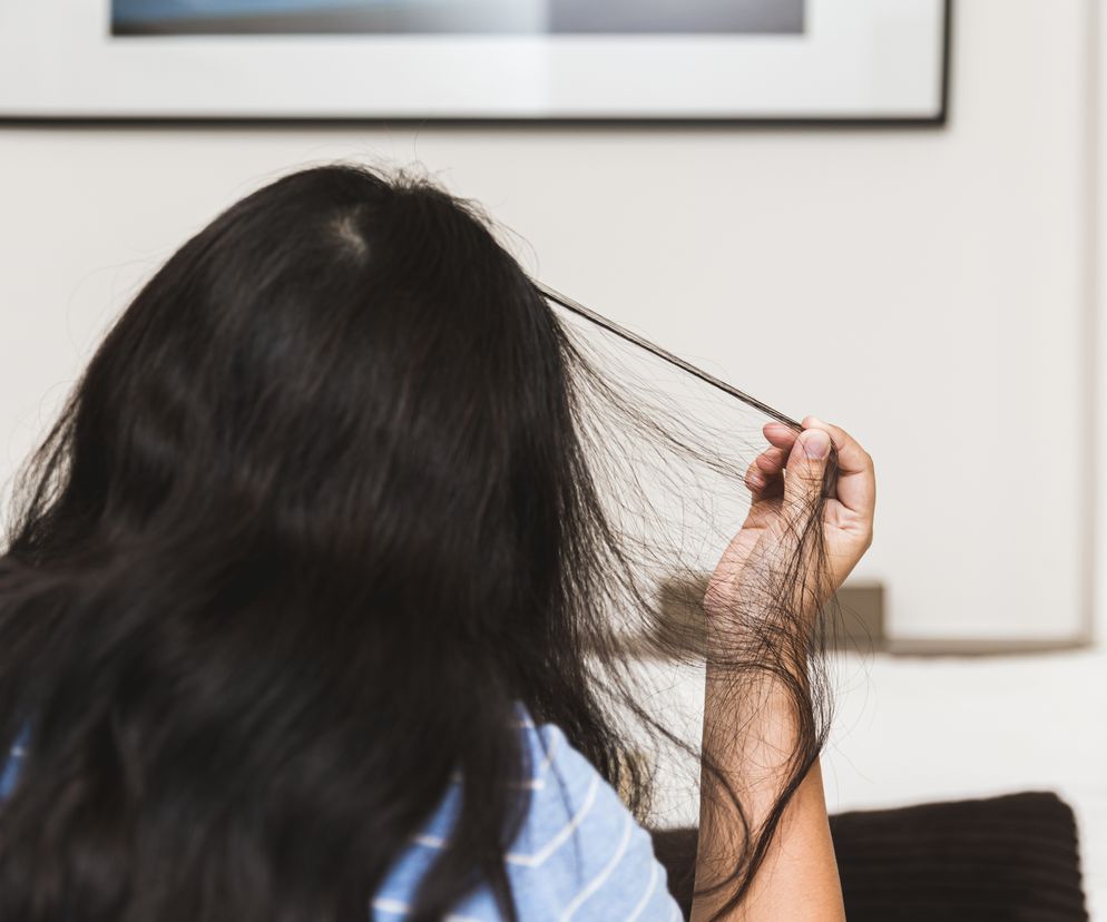 Trichotillomania (TTM), czyli przymusowe wyrywanie włosów. Jak powstaje to zaburzenie i czy można je leczyć?