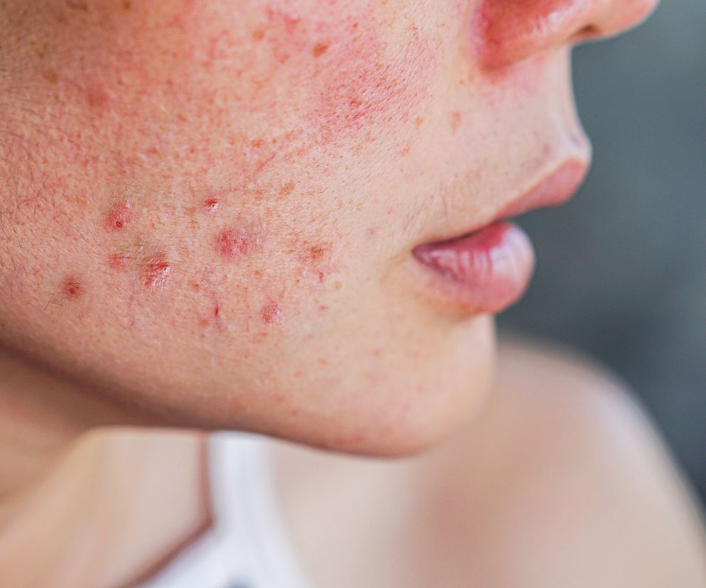 Zbliżenie na twarz kobiety, która ma trądzik