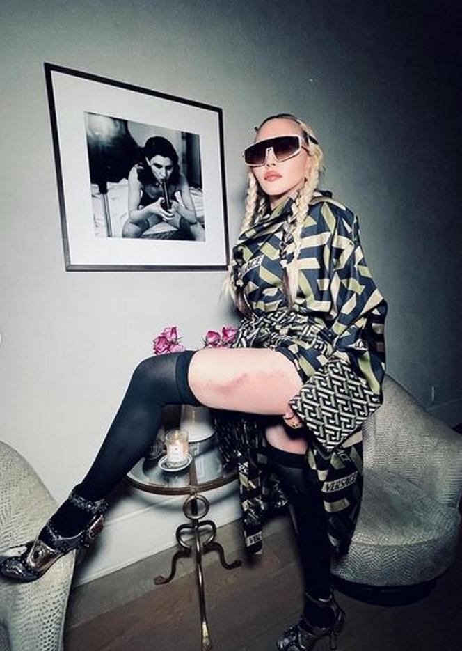 Madonna z wielkim siniakiem. Kto jej to zrobił?
