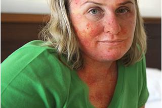 Dermatolog w SZOKU: „Jej skóra była cała w łuskach”