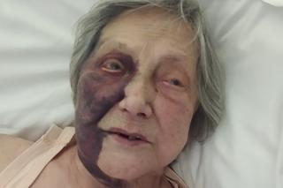  Ogromny krwiak, złamane ząb i oczodół. Opłakany stan seniorki po wyjściu ze szpitala