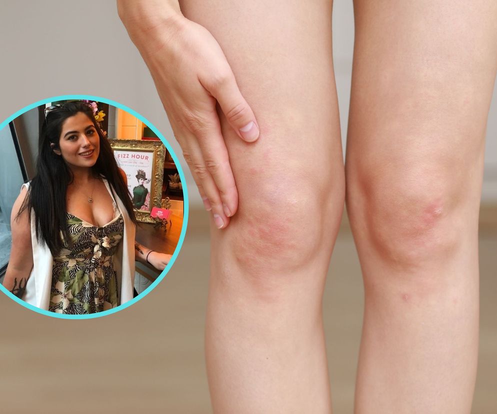 Borykała się z uporczywą wysypką. Ten objaw okazał się nowotworem